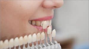 carillas dentales