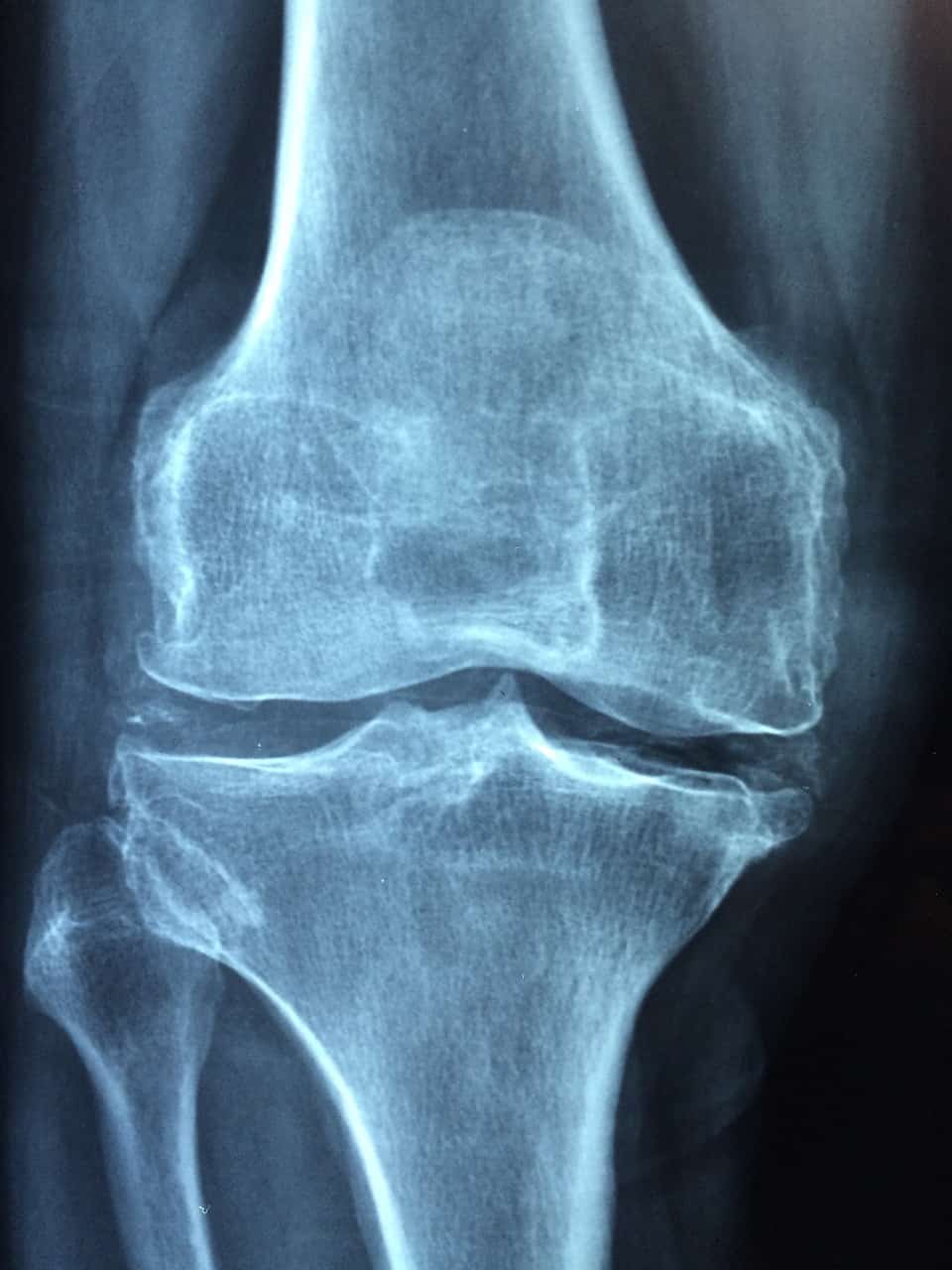 radiografia de una lesion